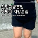 천안계기 | 천안지방흡입 여름이다, 허벅지지방흡입 7주차 후기