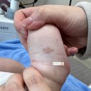 리멤버피부과의원 | 신생아 이소성 몽고반점, 딸기 혈관종 레이저 치료 | 김포리멤버피부과에서 성공적인 치료 후기 ✨