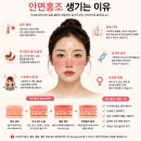 안면홍조크림 얼굴 붉은기 열감 관리후기