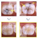 충치 치료 안하면 큰일나요! 이미지