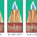 잇몸 내려앉음 이유 및 대처 이미지