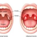 편도 부었을때 증상 및 약 원인 대처법 이미지