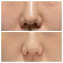 민클리닉의원 | 얀클리닉 포텐자 펌핑팁 , 쥬베룩 스킨부스터 후기!