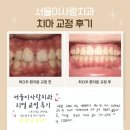 이사랑치과의원 | [서울이사랑치과] 치아교정 전후 비교/ 확 달라진 미소, 실제 환자 치료 후기 :)
