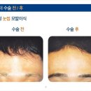 모발이식후기비용‘ 걱정없네