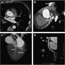 심장 컴퓨터 단층촬영[cardiac computed tomography, cardiac CT] 이미지