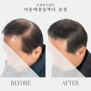 마음에점을찍다두피SMP 이미지