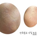 세나 에스테틱 | 부천피부관리샵 세나에스테틱 뉴알라딘필링 솔직후기