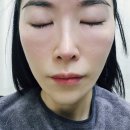 KFC대구시지1 | 대구 수성구 시지피부과 쥬베룩아이 후기: 눈밑꺼짐과 다크서클 개선의 효과와 경험담