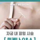 미레나 후기 비용 : 후 여드름 체중증가 출혈 제거 (여성피임) 이미지