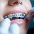 에스(S)리더치과병원 | 잠실 교정치과 임플라인 치과 만족후기