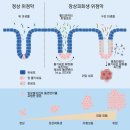 장상피화생 치료 헬리코박터 억제