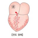 부정맥(Cardiac arrhythmias)증상 이미지