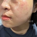 유명약국 | 모낭염 연고 약국 유명제품 다 써본 후기 (사진有)