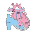 심실중격결손 (Ventricular Septal Defect) 이미지