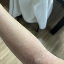 더함축산 | [공지] 아토피 자연치유 후기