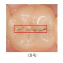 치아 우식증[충치]Dental Caries치과질환 이미지
