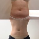 라인이 확 살아나는 줌바댄스 | 복부 지방추출주사 솔직 7주후기 라인변화 가격 붓기는?