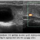 갑상선결절 낭종 물혹 혹이 생겼을때 이미지