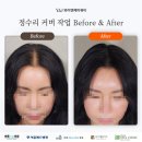 만제원한약 인근 | 강남두피문신 여성 정수리 휑함을 자연스럽게 보완한 후기