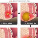 치루 및 (항문 통증 농양 종기 부음 고름) 이미지