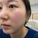 수완하얀피부과의원 | [용인수지]수지온케어365의원 피부과 안면 기미,색소 제거 후기 💖#내돈내산