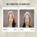 한주프라자 | 홍대 여드름관리 잘하는 곳｜해율한의원 홍대점 여드름·흉터 집중관리 후기