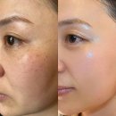 척바른병원 | 기미 제거 레이저 후기 &amp; 가격비교