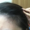 6539 | [공지] [리얼후기] 여성 미녹시딜 3% - 휑했던 가르마가 4개월 만에 빽빽해진 비결 (사진 인증)