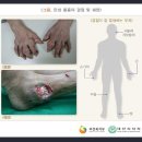 통풍진단(간편가입Ⅲ)보장 특별약관(통풍의 정의 및 진단확정) 이미지