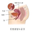 방광질 누공[Vesicovaginal fistula]신장 비뇨기질환 이미지