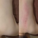 예리다 | [안락동피부관리] 예리다 에스테틱 - 등관리 후기