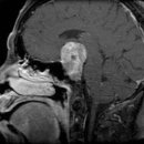 의외로 흔한 뇌암? ‘뇌하수체 종양’이란. 이미지