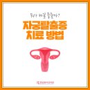 청담여성의원 | 뭐가 제일 좋을까? 자궁탈출증 치료 방법, 청담봄여성의원 드림코어