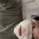 청담고운선의원 | [시술] 첫번째의원 온다리프팅 6만줄 후기