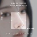 라스트성형외과의원 | 신사 코성형외과 선택 시 후기 흐름을 파악하면서