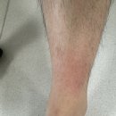 울진군의료원 | [특별한일상]벌에 쏘이고 응급실 간 후기(울진군의료원)