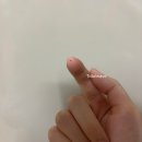 [피부관리] 주근깨 루비레이저 후기 #2