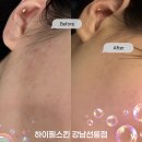(주)시엔터치 | 선릉피부관리 :: 갑자기 올라오는 여드름 해결하러! 하이필스킨 강남선릉점 워터테라피 리얼 후기
