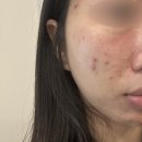 미니골드 잠실신천점 | 잠실 송파나루역피부과 여드름치료 반복되는 트러블 골드PTT 후기
