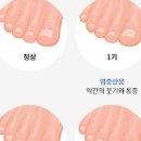 내성발톱 자가 / 병원 (엄지 발톱 염증 발가락 부음 통증) 이미지