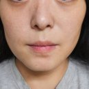 제네시스 | 마곡피부과 피코토닝 엑셀V제네시스 후기