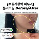 [수원시청역 피부과] 튠리프팅 후기 | 튠라이너 | 튠리프팅 효과 | 튠리프팅 비포애프터 | 인계동 튠...
