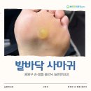 뚜레쥬르면목점 | 중랑구 발바닥 사마귀 제거 : 문제성 손·발톱 클리닉