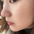 라인코 | 부산코실리프팅 부산하이코 시술 다음날/1주차 변화 기록 비수술 코라인 후기