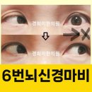 경희이지한의원 | 사시 복시 증상 MRI 검사, 프리즘안경 시지각훈련 시기능훈련 없이 복시 치료하기