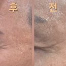 퍼스트 인셀덤 | 51세 남성도 놀란 인셀덤 퍼스트 패키지! 리얼 후기 (전/후 사진 공개)💥