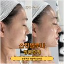 [경산] 대구슈퍼젝션 경산피부관리 스킨델루나 슈퍼젝션 히알루로네이트 솔직후기