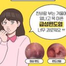 급성 편도선염 및 빨리낫는법 (침삼킬때 목아픔 목멍울 전염 약) 이미지