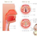 성대결절 및 원인 이미지